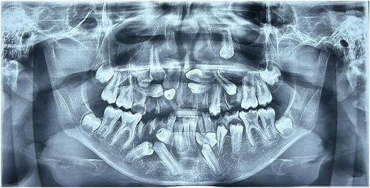 Panoramic dental X-ray showing multiple unerupted permanent teeth embedded in the upper and lower jaws, along with root fragments of primary teeth and two darker, rounded radiolucent areas near a lower molar and the lower right premolar region.