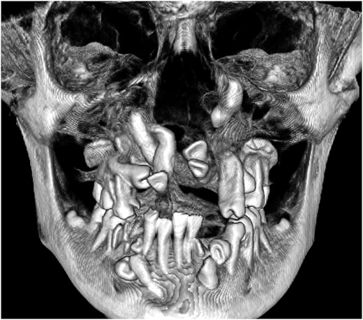 Frontal three-dimensional CT reconstruction of a child's jaws showing multiple unerupted teeth crowded together at abnormal angles and rotations within the upper and lower jawbones, with some retained primary teeth also visible.