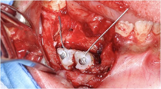 Close-up surgical photograph of an open gum flap with two small metal buttons attached to two exposed tooth crowns, each with a thin wire loop for future orthodontic traction, surrounded by surgical retractors.