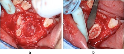 Two surgical photographs: (a) an open bone cavity in the lower jaw showing two exposed unerupted teeth after bone removal; (b) a small extra tooth being lifted out of the lower left jaw with surgical forceps.