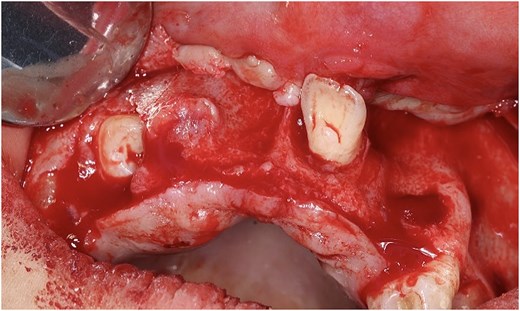 Surgical photograph of the upper jaw with the gum lifted, showing two unerupted tooth crowns exposed within the bone after the surgical opening.