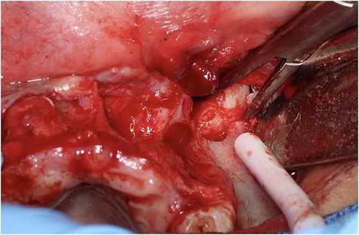 Surgical photograph showing a small opening cut into the bone high in the upper jaw, near the eye socket area, exposing a single unerupted tooth positioned far above the normal biting line.