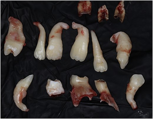 Photograph of fourteen extracted teeth of different sizes and shapes - including primary teeth, permanent teeth, and one small supernumerary tooth - laid out in two rows on a dark cloth.