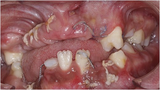 Close-up frontal photograph of the mouth one week after surgery, showing black sutures across the gums with some food debris caught in them and mild redness and swelling in the healing areas.