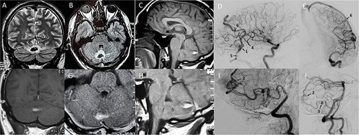 Magnetic resonance imaging and digital subtraction angiography scans displaying multiple cerebral arteriovenous malformations in the left temporal lobe, vermis, and right cerebellar hemisphere, alongside a flow-related aneurysm of the right posterior inferior cerebellar artery.