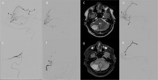 Digital subtraction angiography and magnetic resonance imaging scans demonstrating the first and second stages of cerebellar arteriovenous malformation embolization. The scans display the spread of the embolic agent via the right superior cerebellar artery and right posterior inferior cerebellar artery, alongside an area of postoperative cerebellar ischemia.