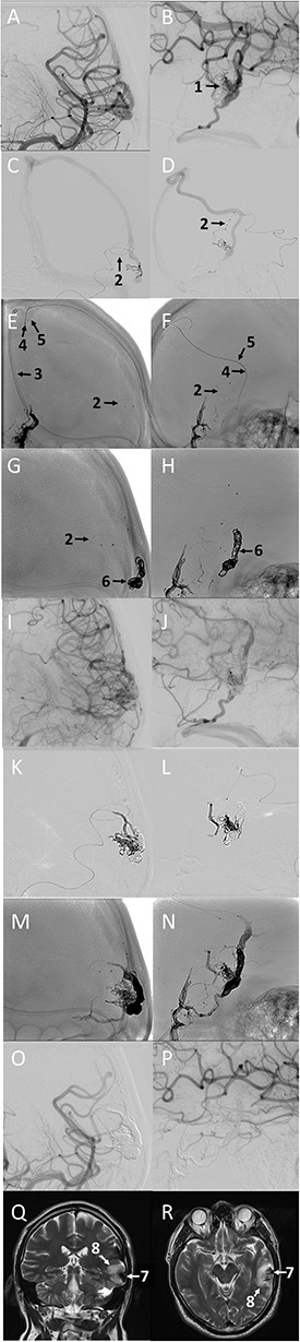 Digital subtraction angiography, craniograms, and magnetic resonance imaging detailing the third stage of treatment. The scans illustrate the total embolization of the left temporal lobe arteriovenous malformation via a combined transarterial and transvenous approach, the placement of microcatheters and coil complexes, the final embolic cast, and postoperative perifocal edema.