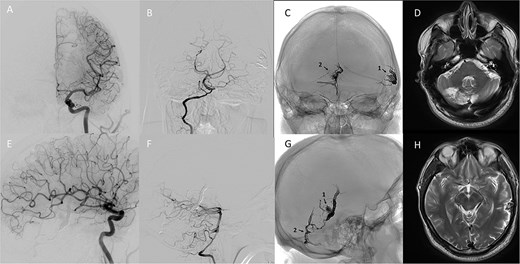 Follow-up digital subtraction angiography, craniograms, and magnetic resonance imaging scans at three months. The images confirm the absence of contrast in the multiple arteriovenous malformations, show the remaining embolic casts, a postischemic cerebellar cyst, and the regression of temporal lobe edema.