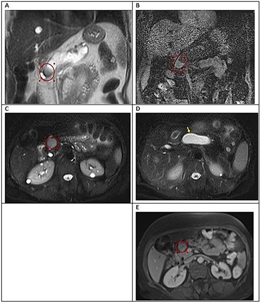 Five-panel abdominal MRI showing dilatation of the main pancreatic duct along the body and tail, with a small enhancing lesion at the pancreatic neck region.