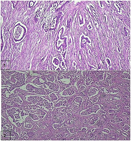 Two-panel light microscopy image showing pancreatic tumour tissue stained with haematoxylin and eosin. The upper panel shows ductal adenocarcinoma; the lower panel shows nests of small neuroendocrine cells.