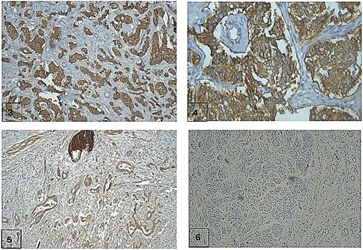 Four-panel immunohistochemistry image showing cytoplasmic staining of neuroendocrine tumour cells with Synaptophysin and Chromogranin A, absent staining of the ductal carcinoma, and minimal Ki-67 nuclear staining indicating low proliferation.