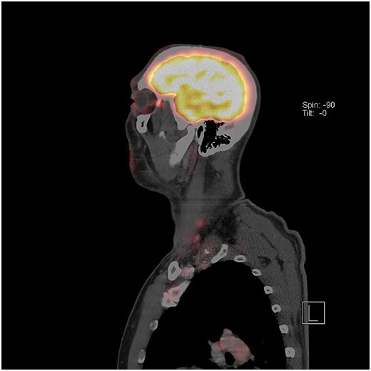 Sagittal PET-CT scan. The brain demonstrates expected diffuse FDG uptake shown in yellow-orange. Two small foci of mild FDG uptake are visible in the left neck at approximately levels III and IV. No pathological uptake is seen at the oropharyngeal primary site.