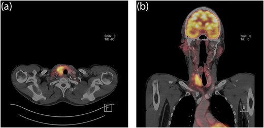 Axial (a) and coronal (b) PET-CT images showing intense FDG uptake in the right thyroid lobe and adjacent right paratracheal lymph nodes, with no pathological uptake at the oropharyngeal primary site or locoregionally.