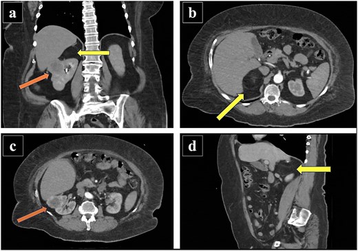 Composite figure comprising four contrast-enhanced abdominal computed tomography images. Panel (a) shows, in the coronal plane, a solid lesion in the upper pole of the right kidney and a separate lesion in the ipsilateral right adrenal gland. Panel (b) shows, in the axial plane, a well-defined fat-attenuation lesion in the right adrenal gland. Panel (c) shows, in the axial plane, the solid tumor in the upper pole of the right kidney. Panel (d) shows, in the sagittal plane, the right adrenal gland lesion. Arrows indicate the corresponding lesions.