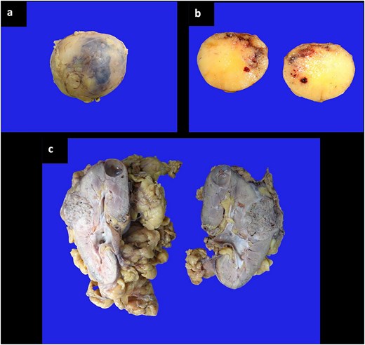 Three photographs of macroscopic surgical specimens. Images (a) and (b) display the right adrenalectomy specimen, showing a sectioned, solid, yellowish tumor with an adipose appearance and reddish hemorrhagic areas. Image (c) shows the sectioned right radical nephrectomy product, revealing a grayish-brown tumor in the middle third and a simple, smooth-walled cyst in the upper pole, surrounded by abundant yellowish adipose tissue.