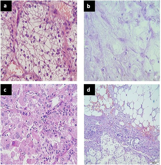 Four histological micrographs. Image (a) shows classic clear cell renal cell carcinoma with nests of cells featuring optically empty cytoplasm and well-defined cell membranes. Image (b) demonstrates sarcomatoid differentiation with spindle-shaped cells arranged in fascicles. Image (c) exhibits rhabdoid differentiation characterized by large, discohesive cells with strongly eosinophilic cytoplasm and prominent nucleoli. Image (d) displays an encapsulated nodule composed exclusively of mature adipose tissue without hematopoietic elements, corresponding to the adrenal lipoma.