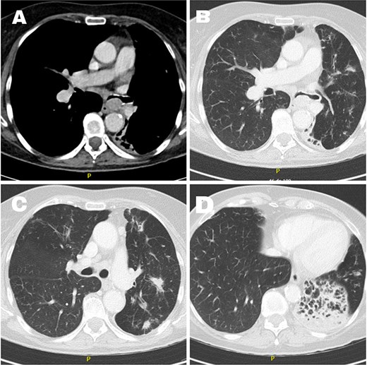 Chest CT images showing a left hilar lesion compressing the left main bronchus, with associated left upper lobe radiopacities and chronic left lower lobe atelectasis with bronchiectasis.