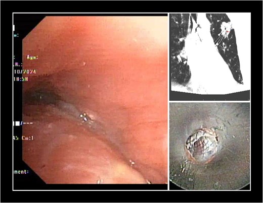 Endoscopic and cone-beam CT images showing bronchoscopic management of a pulmonary mucoepidermoid carcinoma. Panel A shows bronchoscopic view of severe narrowing of the left main bronchus and left lower lobe bronchus caused by the tumor, with purulent secretions. Panel B shows cone-beam CT guidance during transbronchial biopsy. Panel C shows the endoscopic view of a fully covered self-expanding bronchial stent placed via rigid bronchoscopy.