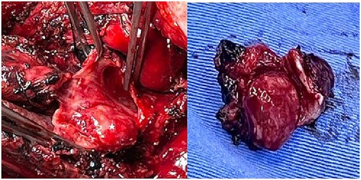 Intraoperative images showing an endobronchial tumor occupying the left main bronchus and its complete surgical resection.