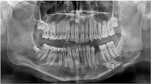 Panoramic radiograph showing a tooth near the inferior border of the mandible.