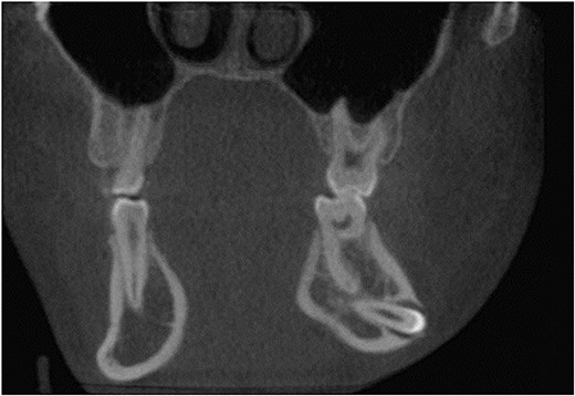 Coronal CBCT showing ectopic tooth and buccal cortical perforation.
