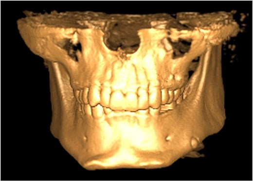 3D reconstruction showing inferior migration of the ectopic premolar.
