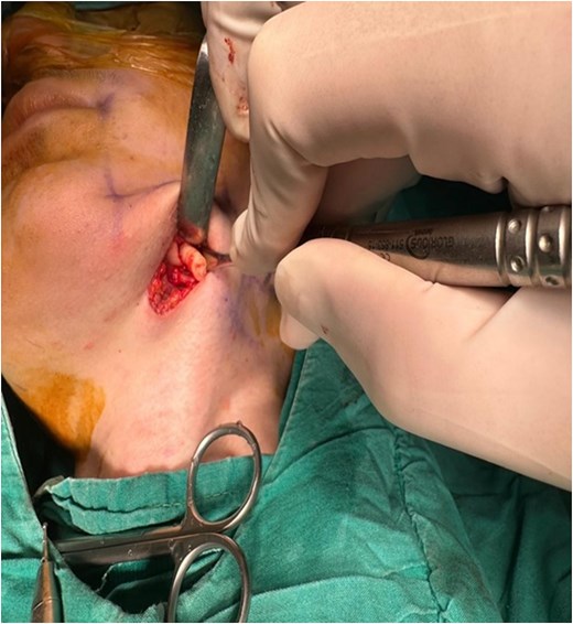 Surgical exposure of ectopic tooth via submandibular approach.