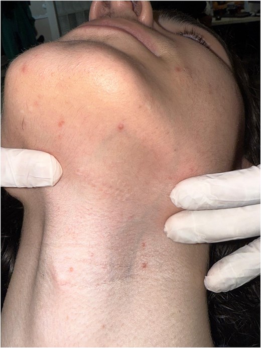 Healed submandibular incision with minimal scarring.