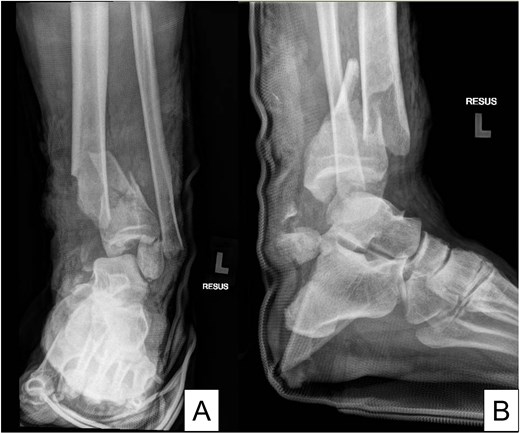 X-rays of the left ankle in anteroposterior and lateral views.