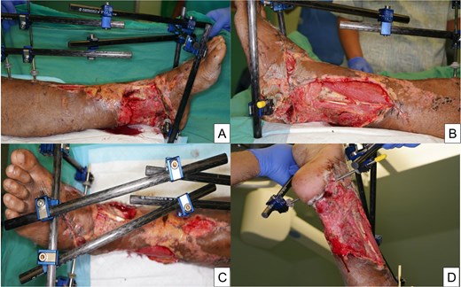 Clinical photographs showing extensive left lower limb soft tissue defect.