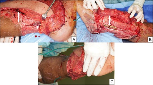 Clinical photographs showing internal fixation of left lower limb fractures and free latissimus dorsi musculocutaneous flap coverage.