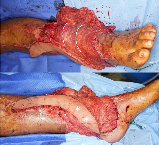 90 degree Transposition of the latissimus dorsi musculocutaneous flap distal skin paddle superiorly.