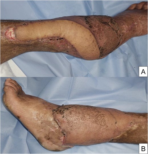 One month follow-up showing the medial and lateral views of the left lower limb.