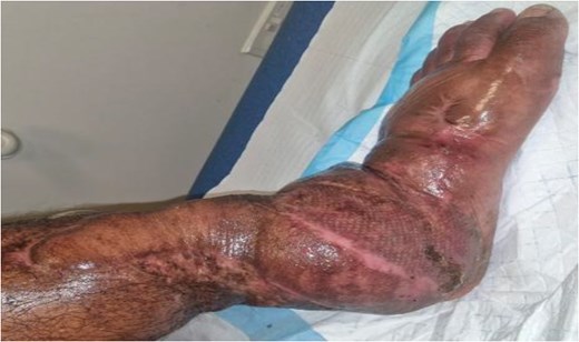 One year follow-up showing complete healing of the left lower limb.