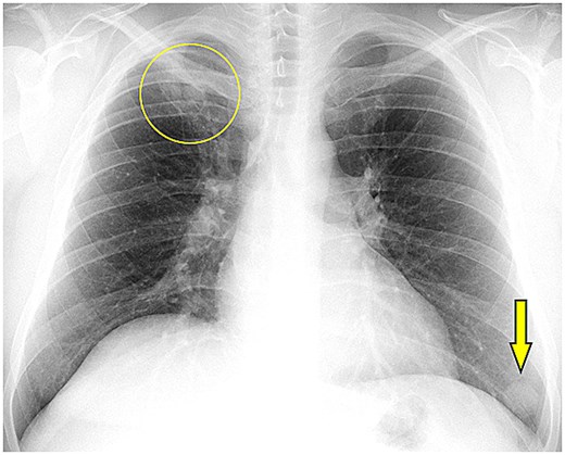 Chest radiograph showing a cavitary lesion in the right upper lung and a separate well-circumscribed rounded opacity in the left lower lung, representing bilateral pulmonary hydatid disease with one ruptured and one intact cyst.