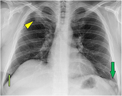 Postoperative chest radiograph demonstrating residual right upper lung opacity at the site of surgical cavity closure, with persistence of a rounded left lower lung cystic lesion and expected postoperative skin staples.