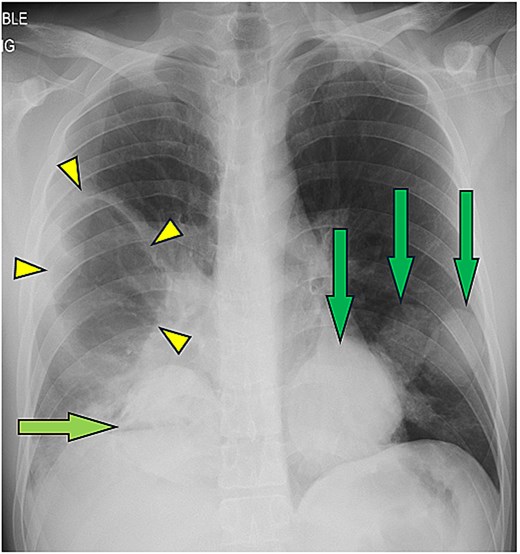 Chest radiograph showing a cavitary lesion in the right upper to mid lung and multiple well-defined rounded opacities in both lungs, consistent with multiple pulmonary hydatid cysts, including a ruptured cyst on the right.