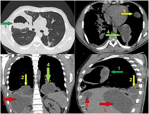 Composite chest and upper abdominal CT images demonstrating multiple hydatid cysts involving both lungs and the liver, including a ruptured right upper lobe cyst with an air–fluid level and several additional intact pulmonary and hepatic cysts.