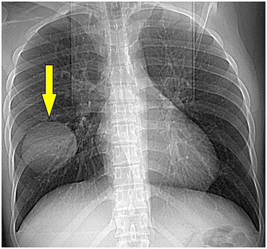 Portable chest radiograph showing a solitary, well-circumscribed rounded opacity in the right mid to lower lung, consistent with an intact pulmonary cyst.