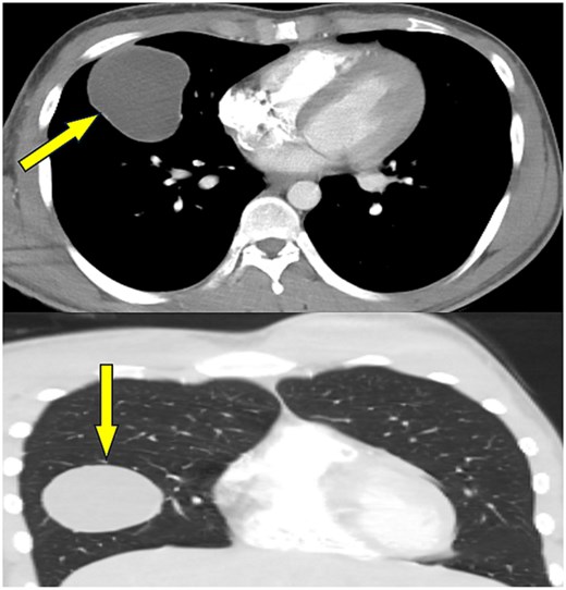 Chest CT image obtained during trauma assessment showing a well-defined unilocular cystic lesion within the right middle lobe, compatible with an intact pulmonary hydatid cyst and without evidence of rupture.