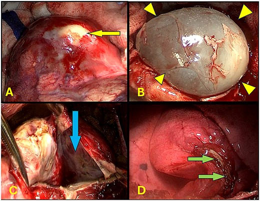 Composite intraoperative photographs demonstrating key stages of lung-sparing surgical management of a pulmonary hydatid cyst, including exposure of the germinal membrane, removal of the intact cyst, the residual intrapulmonary cavity after cystectomy, and closure of the cavity by capitonnage suturing.