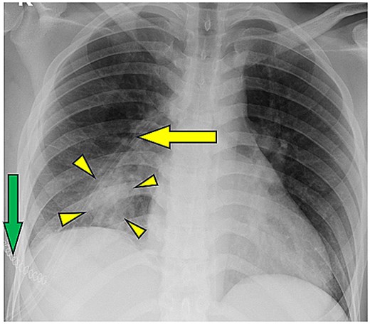 Postoperative chest radiograph demonstrating full expansion of the right lung following hydatid cyst surgery, with expected residual opacity at the site of cavity obliteration, a right-sided chest drain in situ, and overlying skin staples.